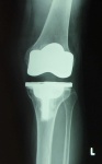 術後左膝X線